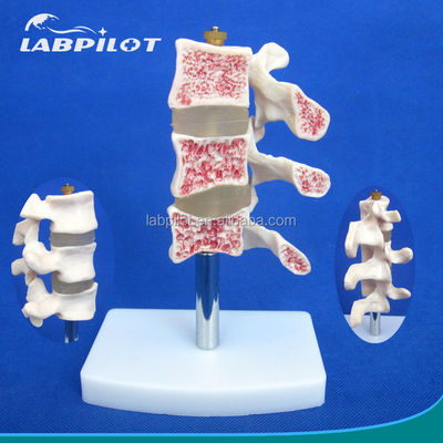 Modelos educacionais avançados de PVC Cutaway Osteoporose da coluna Lesões da vértebra lombar