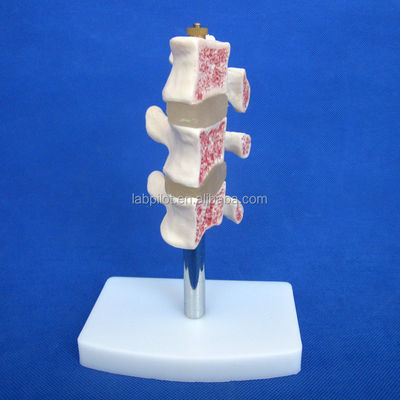 Modelos educacionais avançados de PVC Cutaway Osteoporose da coluna Lesões da vértebra lombar