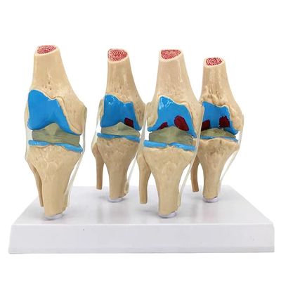 Demonstração anatômica do Modelo de Patologia Articular do Joelho Humano para a Ciência Médica