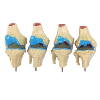 Demonstração anatômica do Modelo de Patologia Articular do Joelho Humano para a Ciência Médica