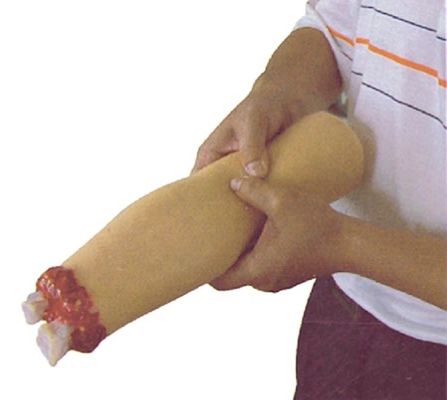 Modelo de cuidados de enfermagem de trauma Amputação do braço e hemostase para tratamento de feridas de membros superiores