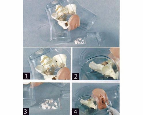 Modelo de Obstetrícia-Ginecologia Simulador de Curetagem Uterina Transparente para Escola de Enfermagem