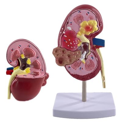 Modelo de rim patológico de PVC para escolas médicas e hospitais de urologia