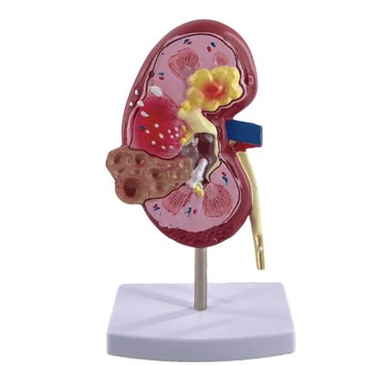 Modelo de rim patológico de PVC para escolas médicas e hospitais de urologia