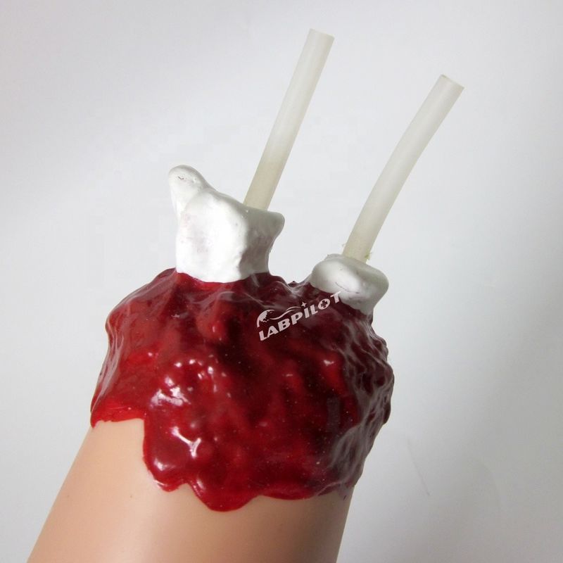 Modelo de cuidados de enfermagem de trauma Amputação do braço e hemostase para tratamento de feridas de membros superiores